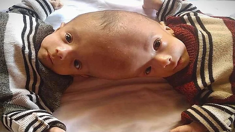 إجراء عملية فصل التوأم السيامي اليمني غدا بمدينة الملك عبدالعزيز الطبية