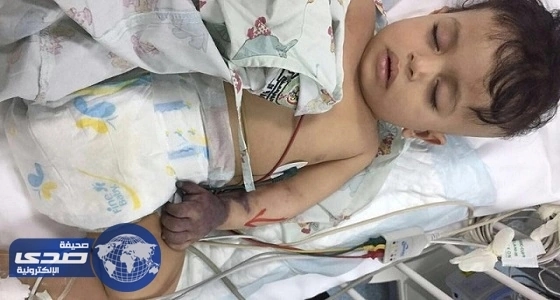 الأطباء يقررون بتر يد الطفل " جسار " بسبب خطأ طبي