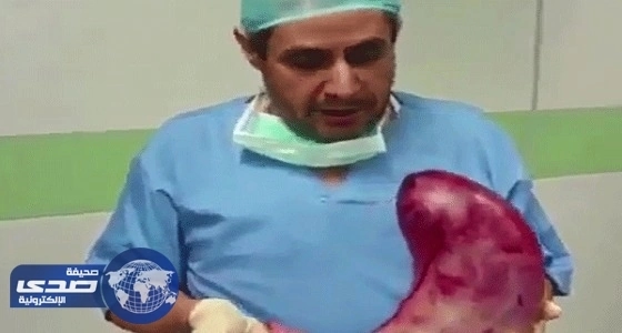 بالفيديو.. طبيب يحمل معدة بشرية ضخمة