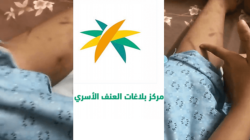 العنف الأسري يتفاعل مع حالة طفلة تعرضت للتعنيف من قبل خادمة (فيديو)