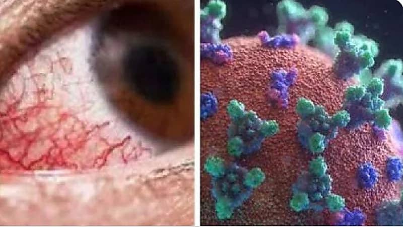 ابنة أول مصابة بالفطر الأسود بــ"مصر" تروي تفاصيل إصابة والدتها واكتشافهم المرض