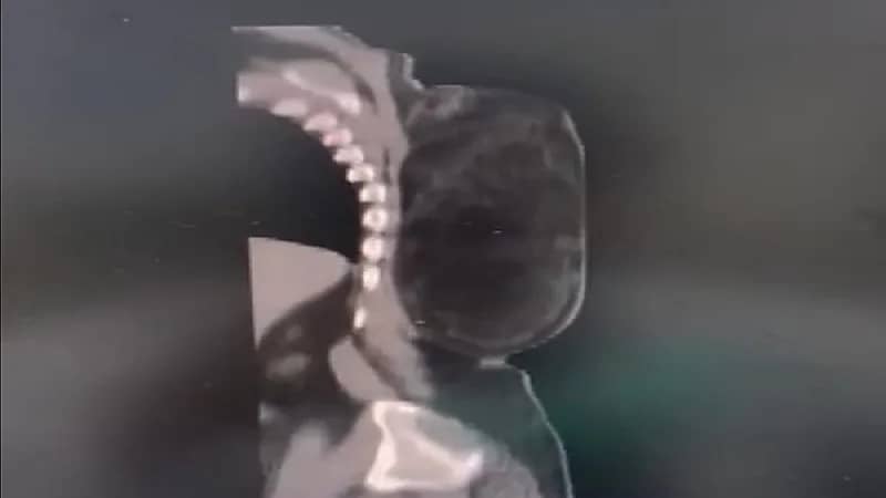 شاهد.. استئصال ورم مرتجع يزن ٣ كيلو من ظهر مريض