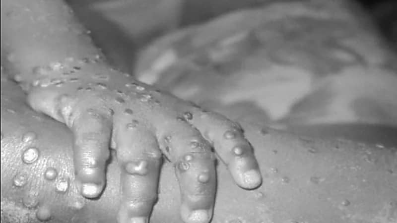 الصحة العالمية تؤكد أن مئات الحالات من جدري القرود قد تكون غير مكتشفة