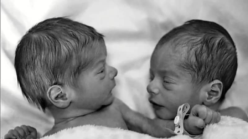 في حالة نادرة امرأة برحمين تلد توأمًا كل مولود في رحم