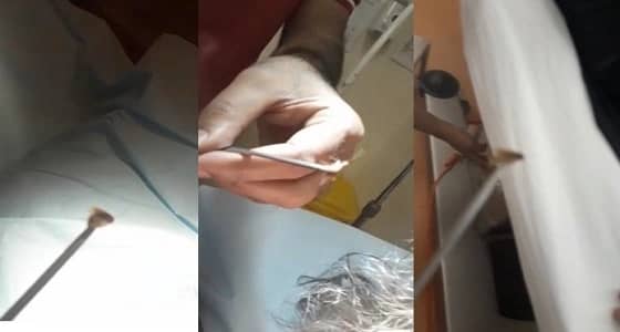 بالفيديو.. طوارئ " أضم العام " تنجح في استخراج " حشرة " من أذن طفلة