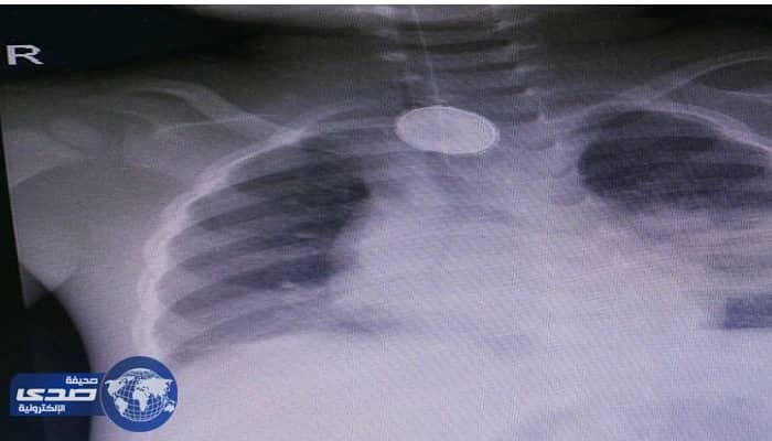 انقاذ حياة طفل في عملية نادرة بولادة مكة