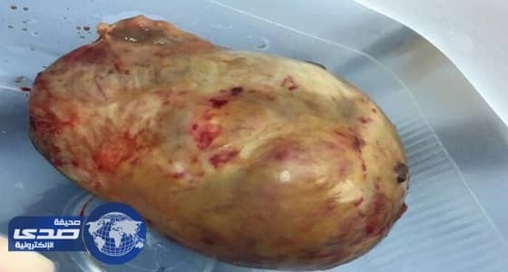 نجاح عملية استئصال ورم حميد بحجم ١١سم لمريضة  
