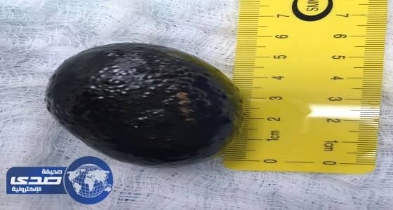 فريق طبي بمستشفى الخميس العام يستخرج حصوة بطول 6 سم من مثانة مريض