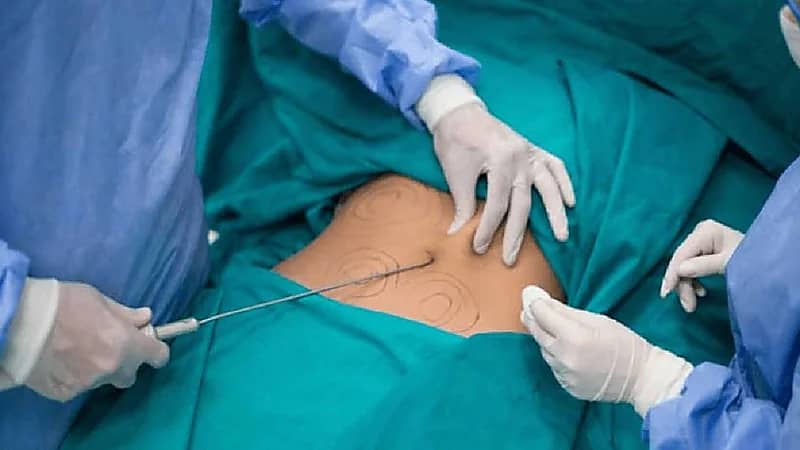 عملية شفط دهون تتسبب في نزيف 8 ساعات لسيدة عربية