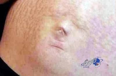 ملامح جنين تظهر على بطن أمه