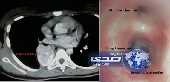 استئصال ورم سرطاني من رئة فتاة السابعة عشرة بمستشفى عسير المركزي‎