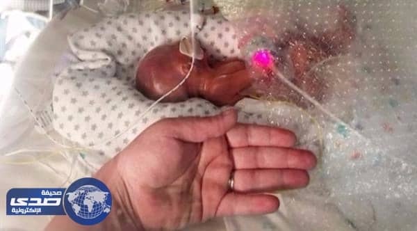 طفل ولد وزنه نصف كيلو يتمكن من النجاه ويٌخالف توقعات الأطباء