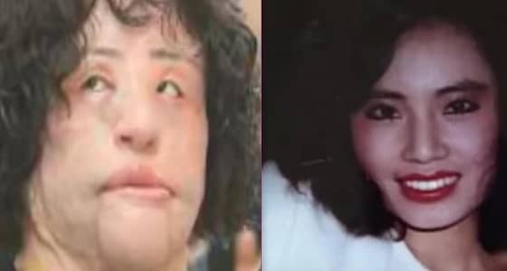 بالصور..عمليات تجميل انتهت بنتائج كارثية