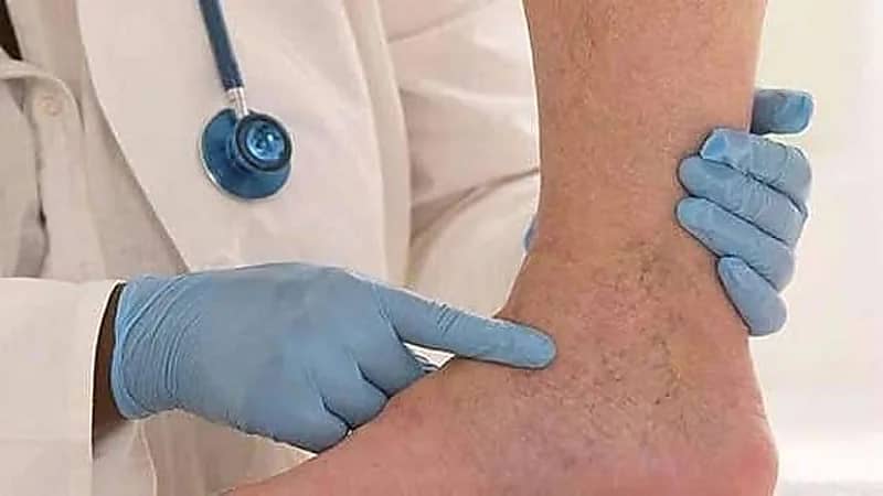 أعراض تُنذر بحدوث جلطة الدم