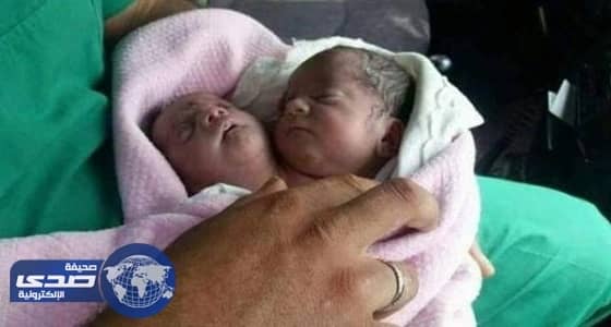 بالصور.. تشوه مواليد وحالات مستعصية نتيجة لهجمات الأسد الكيماوية