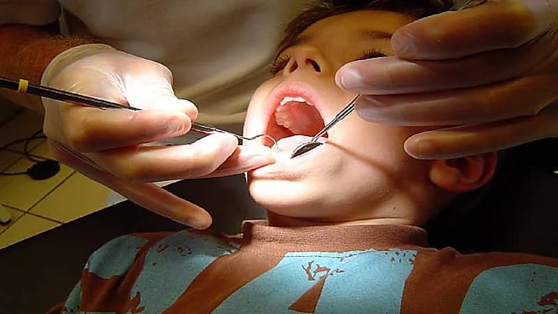 ما لا تعرفه عن الحشوات السادة اللاصقة للأسنان عند الأطفال