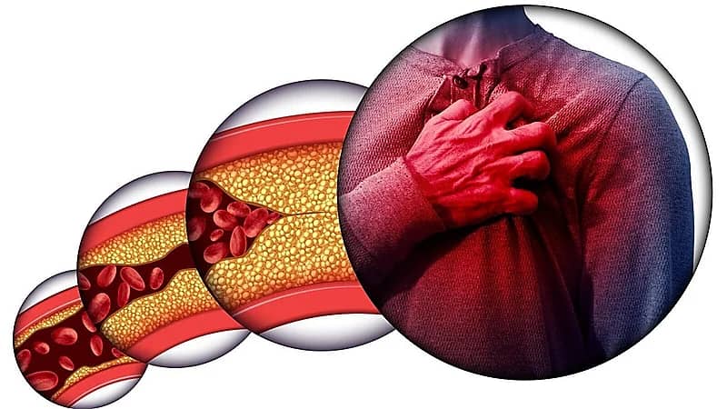 بالفيديو.. الكوليسترول الوراثي في الخليج الأعلى عالميا