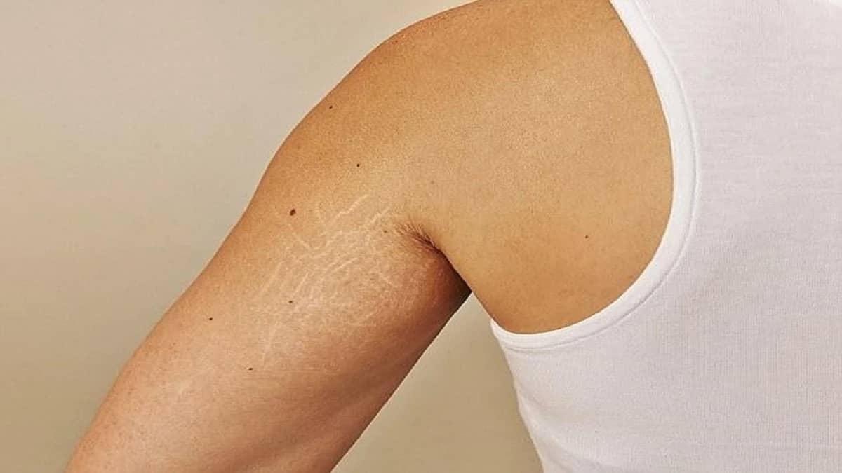 علاجات منزلية تساعد في التخلص من علامات التمدد على الجسم