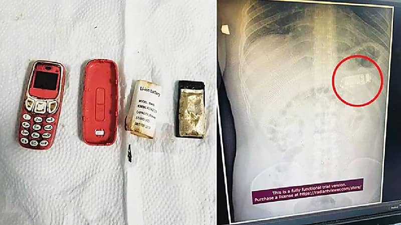 رجل يبتلع هاتف نوكيا ويدفعه لإجراء عملية جراحية