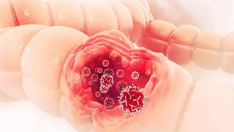 علامات تحذرك من انتشار سرطان الأمعاء