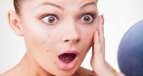 3 مستحضرات طبيعية تخلصك من البثور