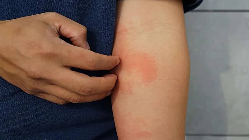 علامات مرئية على الجلد تكشف عن الإصابة بـ"السكري"