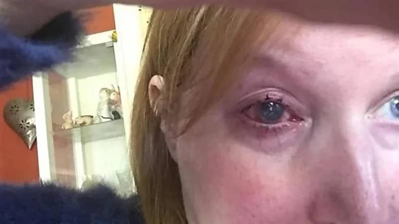 امرأة بريطانية تفقد عينها بسبب عدسات لاصقة