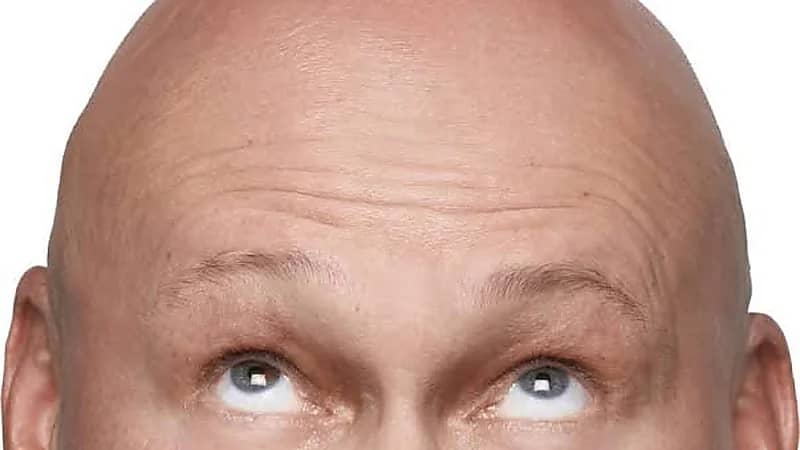 الصلع أنواعه وطرق علاجه .. فيديو