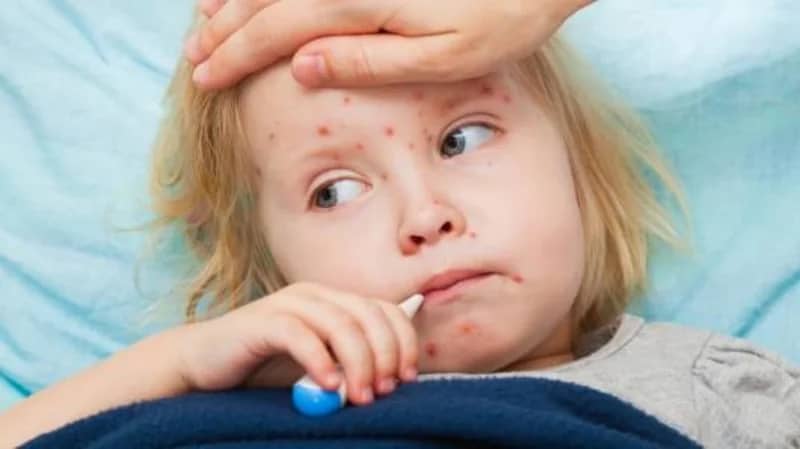 الصحة العالمية تحذر من حدوث وفيات بسبب انتشار الحصبة