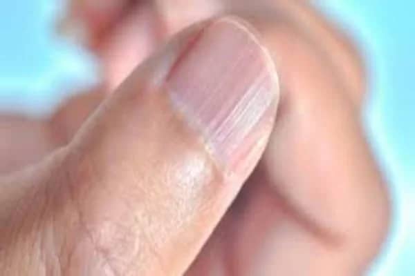 الكشف عن أعراض نقص الزنك الحاد 