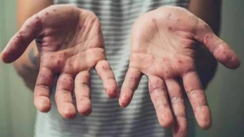 دولة جديدة تسجل أول حالة وفاة بجدري القرود