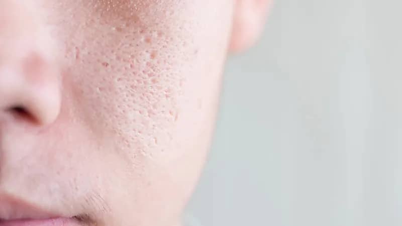 بالفيديو.. أسباب توسّع المسامات في البشرة وظهور الرؤوس السوداء