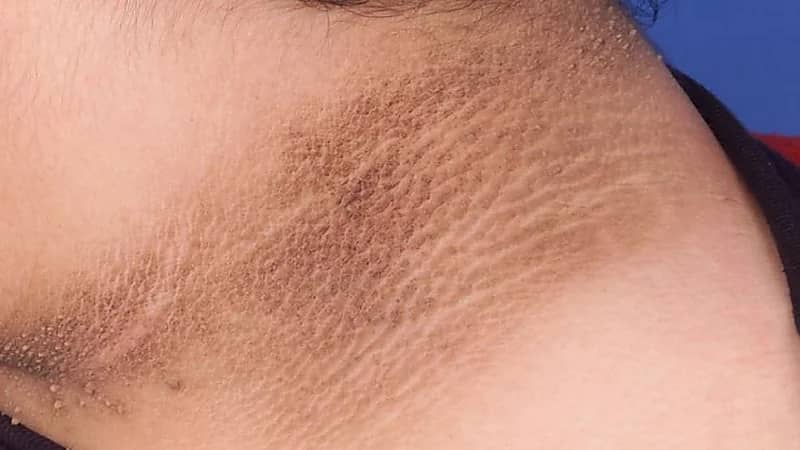 أسباب مشكلة اسمرار الرقبة وطرق علاجها