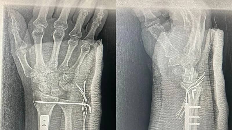 نجاح أول عملية لتثبيت كسر عظمتي الساعد لشاب بتقنية التصوير الشعاعي بمستشفى تمير