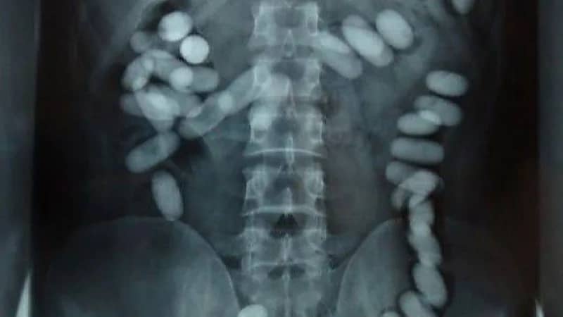 السجن 10 سنوات لآسيوي هرب مخدرات داخل أحشائه