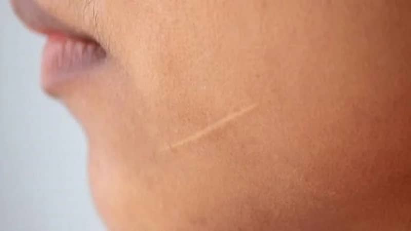 استشاري: شكل الندبة ولونها هو ما يحدد طريقة علاجها .. فيديو