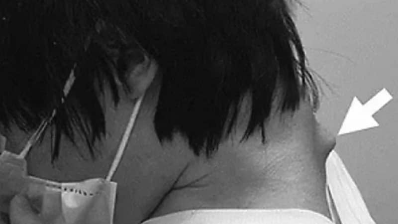 إصابة شاب بمتلازمة الرأس المتدلي بسبب الجوال