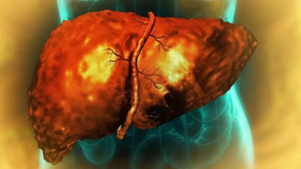 دراسة: الأنظمة الغذائية الغنية بالدهون قد تغير خلايا الكبد وتزيد خطر السرطان