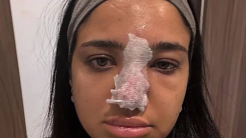 حقنة فيلر كادت تحرم بلوغر  مصرية من أنفها وبصرها .. فيديو وصور