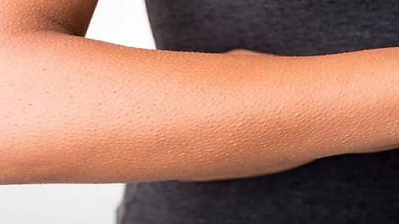 السكر والشمع أفضل طريقة للتخلص من جلد الوزة