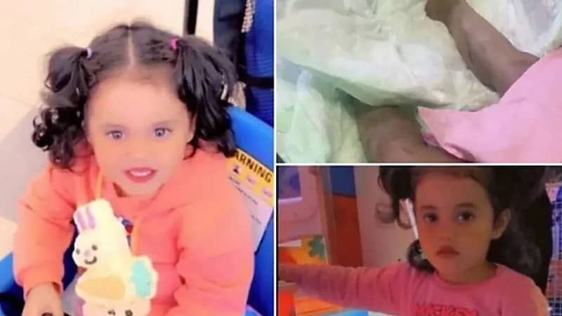 والد الطفلة ضحية الأسيد: لن أتنازل عن حق ابنتي