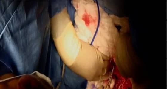 عملية فصل التوأم السيامي الفلسطيني تدخل مرحلة فصل الطرف السفلي المشترك