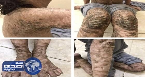 ⁠⁠⁠⁠⁠بالصور.. تحسن حالة " طفلة الجلد السمكي " بعد تلقيها العلاج بالهند