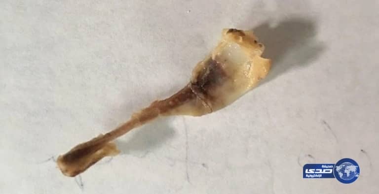 استخراج عظم علق بحلق طفل دون تدخل جراحي في الأفلاج