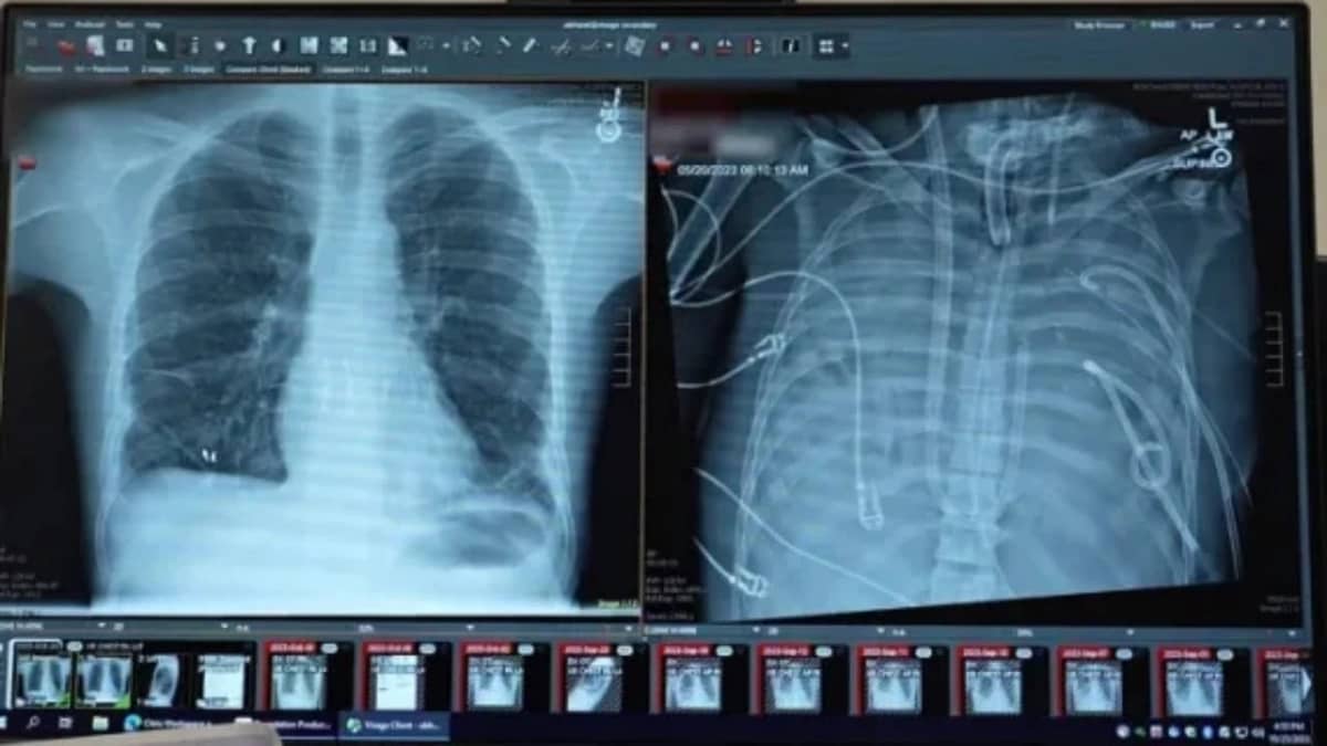 إنجاز غير مسبوق .. شاب يعيش لمدة 48 ساعة بلا رئتين وينجو من الموت