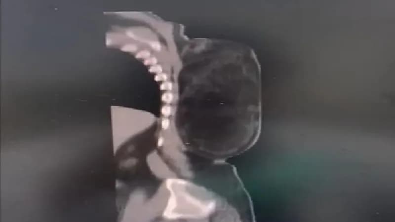 شاهد.. استئصال ورم مرتجع يزن ٣ كيلو من ظهر مريض