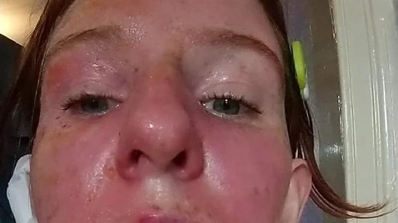 فتاة تتعرض لهجوم بالماء المغلي بسبب الفئران