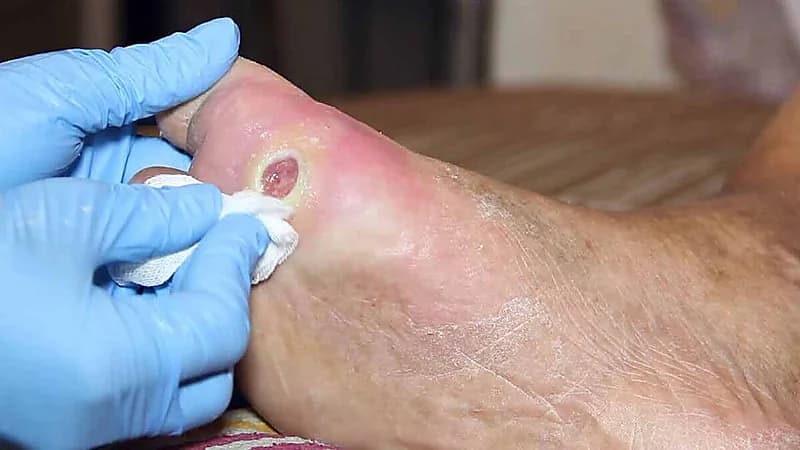 بالفيديو.. استشاري يحذر مرضى القدم السكري من العلاج الشعبي
