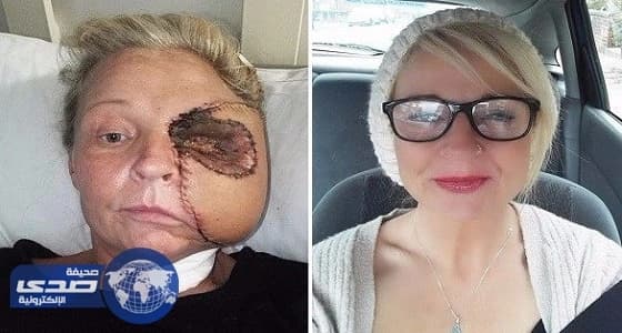 بريطانية تخسر نصف وجهها بعدما ضربت رأسها في الفرن