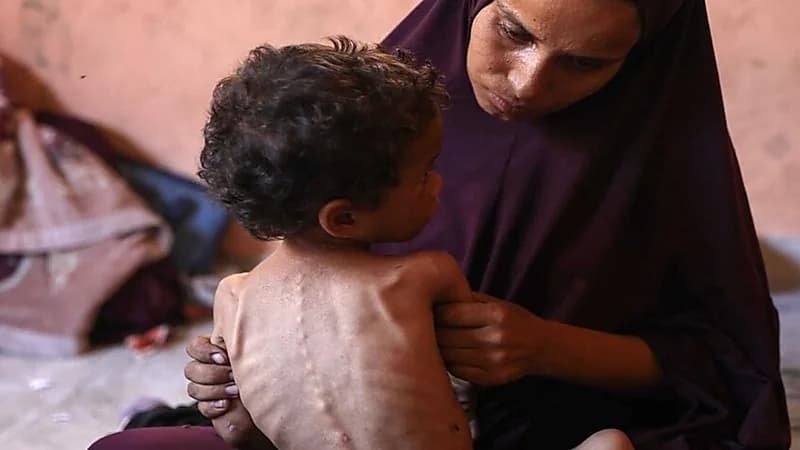 فيروس قاتل يشبه كورونا يهدد حياة الأطفال الجوعى في غزة